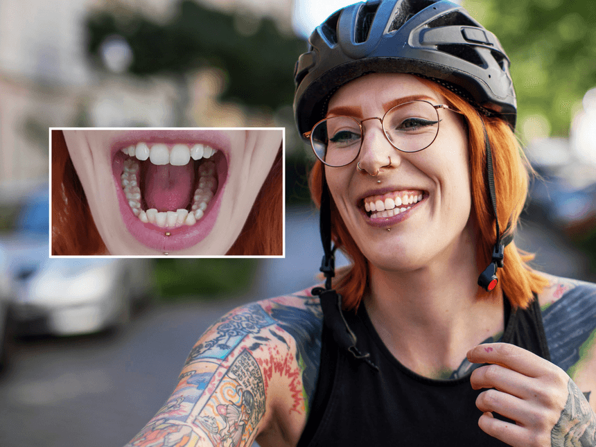 Résultats avant-après du port d'aligneurs dentaires invisibles DR SMILE auprès de la patiente Swantje