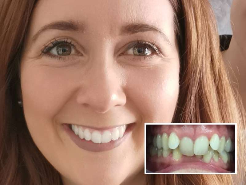 Photos avant-après de la correction d'une supraclusion dentaire avec les aligneurs DR SMILE