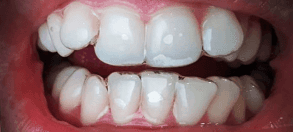 Photo de la dentition de la patiente Simin souffrant de dents encombrées avant son traitement DR SMILE