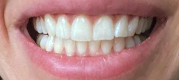 Photo de la dentition de la patiente Dilara ne présentant plus de diastème après son traitement par aligneurs DR SMILE