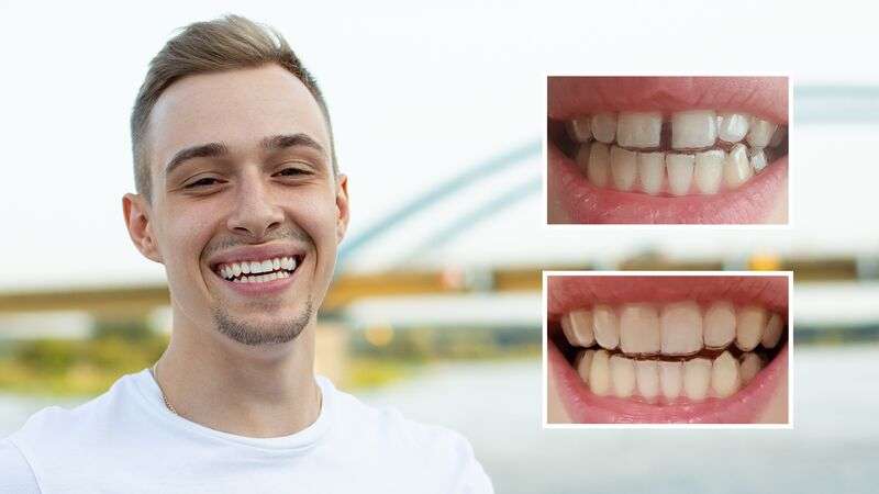 Résultats avant-après du port d'aligneurs DR SMILE pour combler l'espace entre deux dents