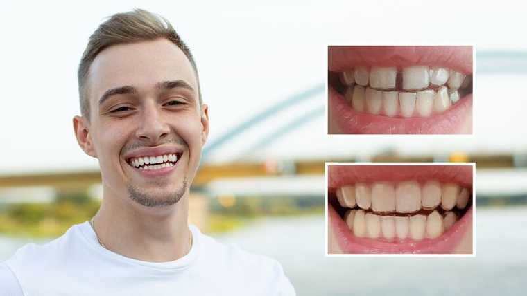 Résultats avant-après du port d'aligneurs DR SMILE pour combler l'espace entre deux dents - Jakub