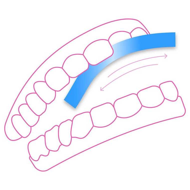 Illustration d'un stripping dentaire