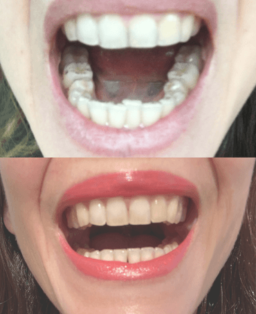 Aligneurs dentaires et alignement dentaire à Lyon