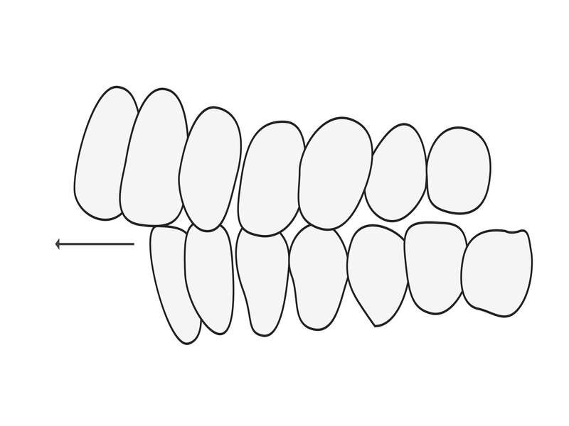 Illustration d'un overjet dentaire, les dents en avants