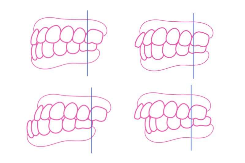 Illustrations de différents types de malocclusions dentaires, par DR SMILE