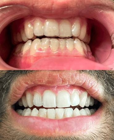 Comment bien entretenir ses aligneurs ? - Dentiste Nice - Implants  dentaires Nice - Cabinet dentaire du Dr DISS