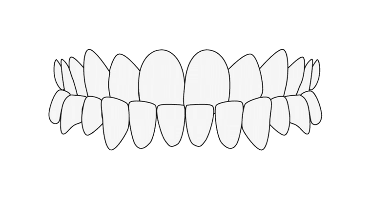 Illustration d'occlusion en bout à bout