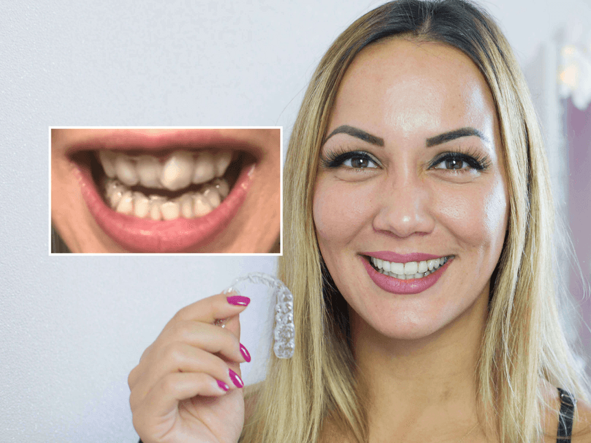 Résultats avant-après du port d'aligneurs DR SMILE auprès de la patiente Aylin