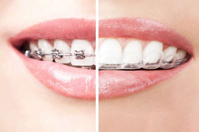 Les différents types d'appareils dentaires